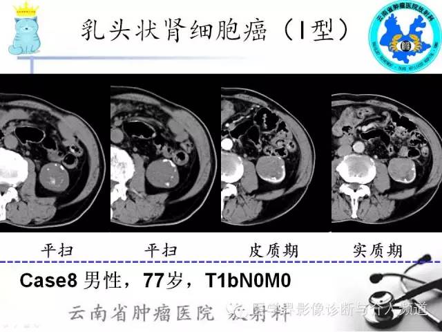 【PPT】肾细胞癌CT诊断及鉴别诊断