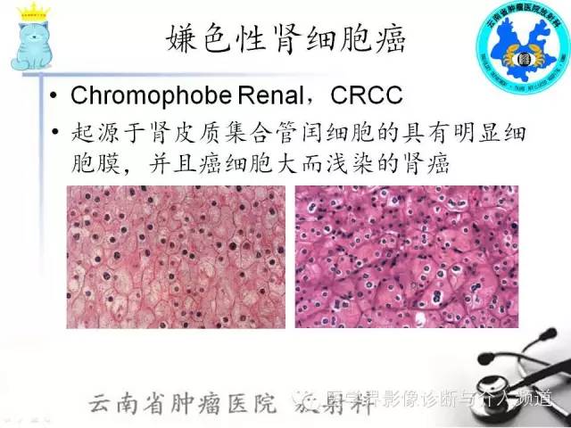 【PPT】肾细胞癌CT诊断及鉴别诊断