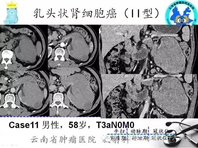 【PPT】肾细胞癌CT诊断及鉴别诊断