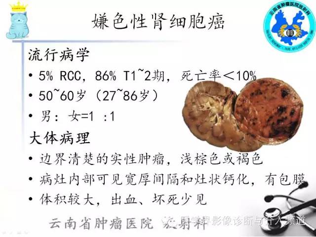 【PPT】肾细胞癌CT诊断及鉴别诊断