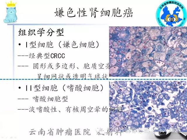 【PPT】肾细胞癌CT诊断及鉴别诊断