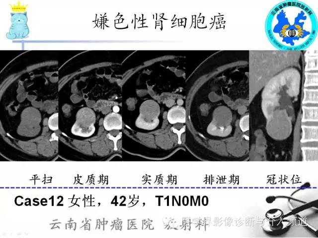 【PPT】肾细胞癌CT诊断及鉴别诊断