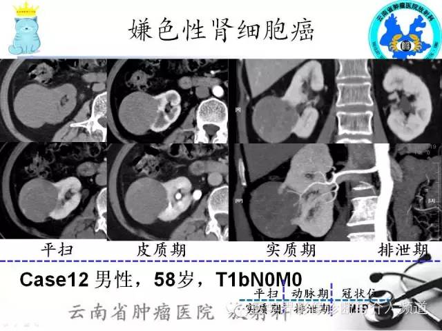 【PPT】肾细胞癌CT诊断及鉴别诊断