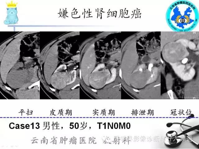 【PPT】肾细胞癌CT诊断及鉴别诊断