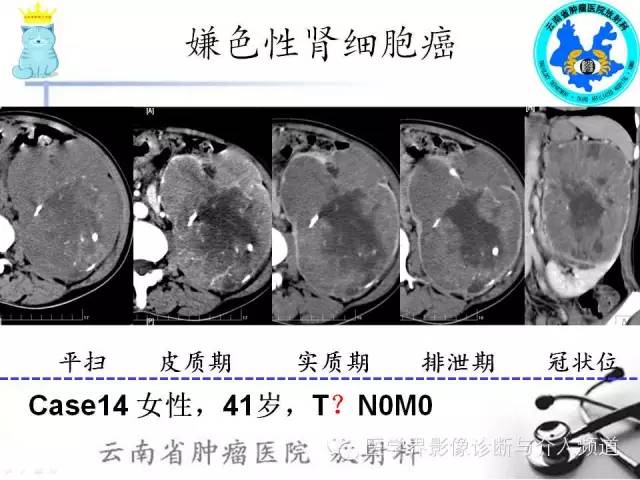 【PPT】肾细胞癌CT诊断及鉴别诊断