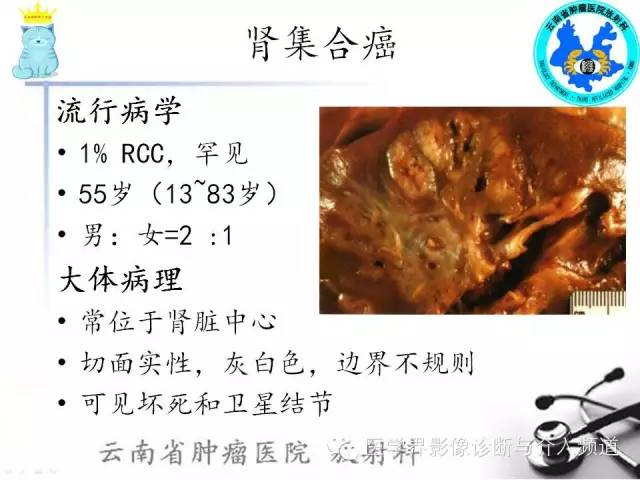【PPT】肾细胞癌CT诊断及鉴别诊断
