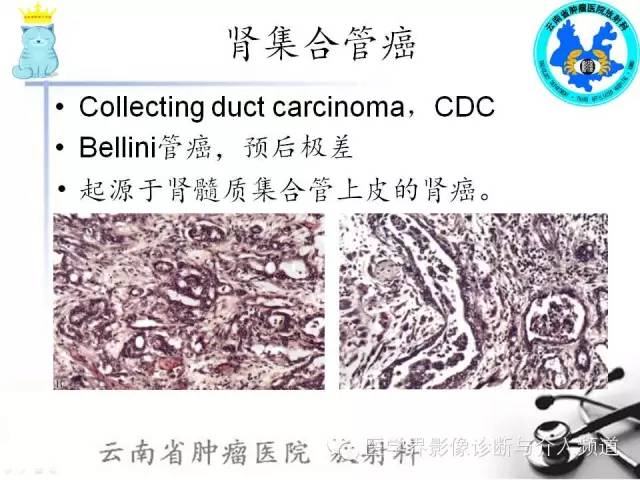 【PPT】肾细胞癌CT诊断及鉴别诊断