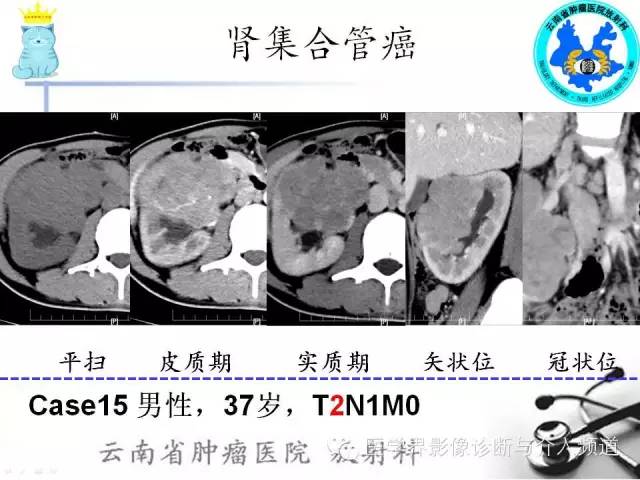 【PPT】肾细胞癌CT诊断及鉴别诊断