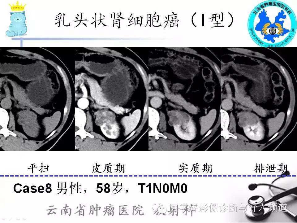 【PPT】肾细胞癌CT诊断及鉴别诊断