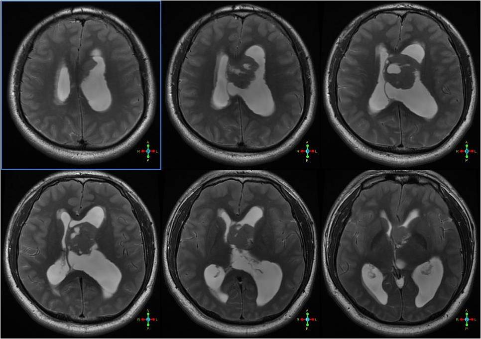 【病例】脑室中枢神经细胞瘤1例MR影像表现 【病例】脑室中枢神经细胞瘤1例MR影像表现