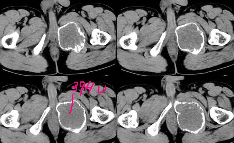 【病例】耻骨非骨化性纤维瘤1例CT影像表现 【病例】耻骨非骨化性纤维瘤1例CT影像表现