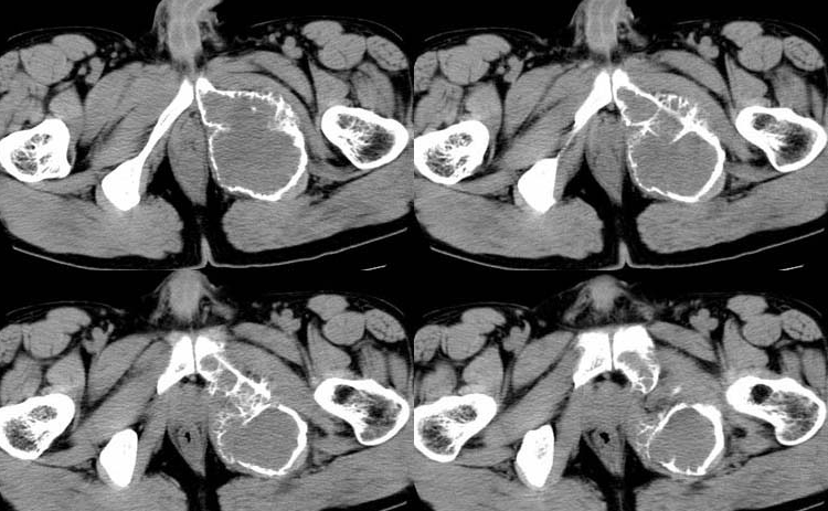 【病例】耻骨非骨化性纤维瘤1例CT影像表现 【病例】耻骨非骨化性纤维瘤1例CT影像表现