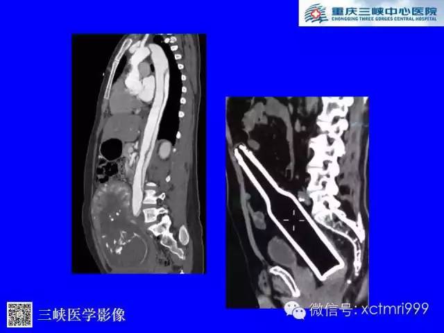 【PPT】腹内疝的影像诊断
