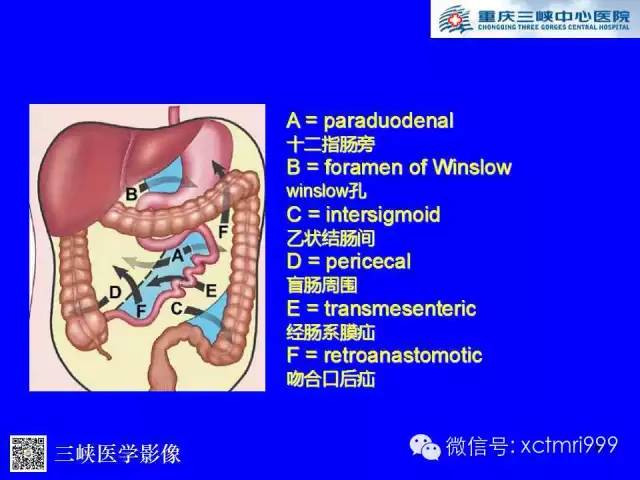 【PPT】腹内疝的影像诊断