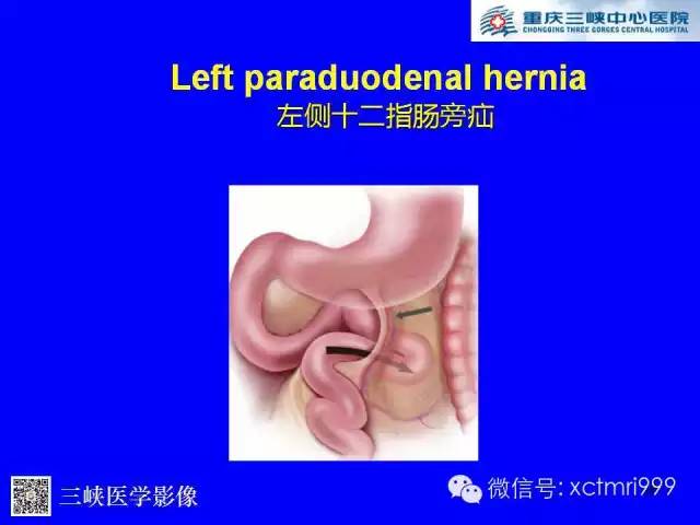 【PPT】腹内疝的影像诊断