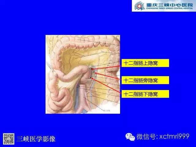 【PPT】腹内疝的影像诊断
