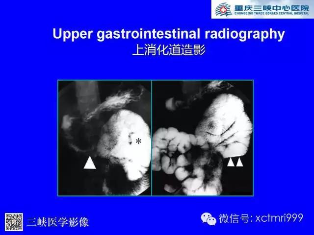 【PPT】腹内疝的影像诊断