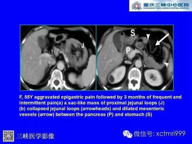 【PPT】腹内疝的影像诊断