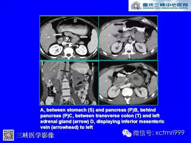 【PPT】腹内疝的影像诊断
