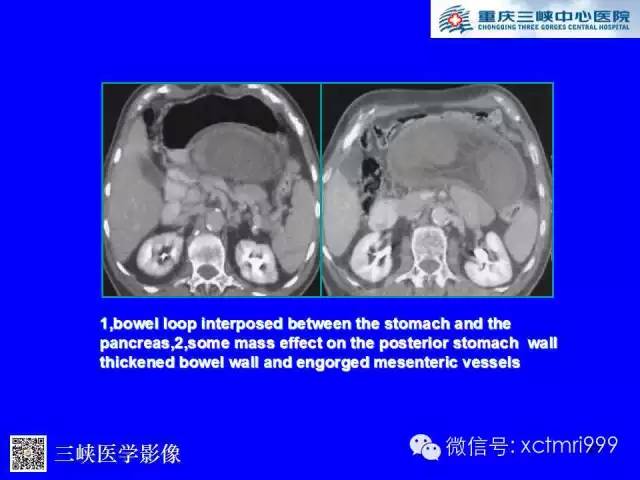 【PPT】腹内疝的影像诊断