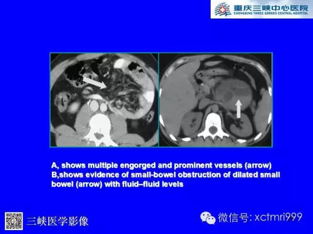 【PPT】腹内疝的影像诊断