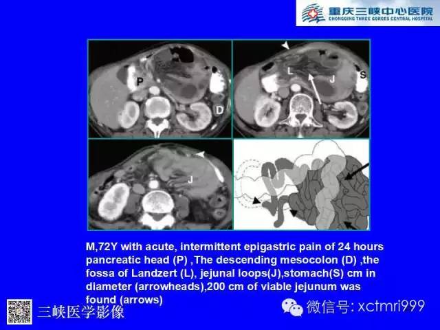 【PPT】腹内疝的影像诊断