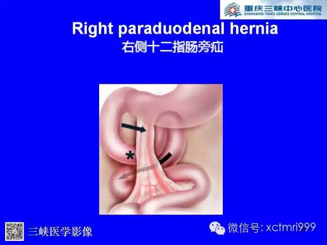 【PPT】腹内疝的影像诊断