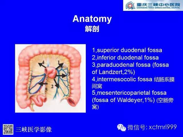 【PPT】腹内疝的影像诊断