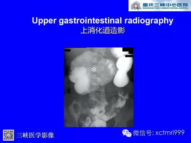 【PPT】腹内疝的影像诊断