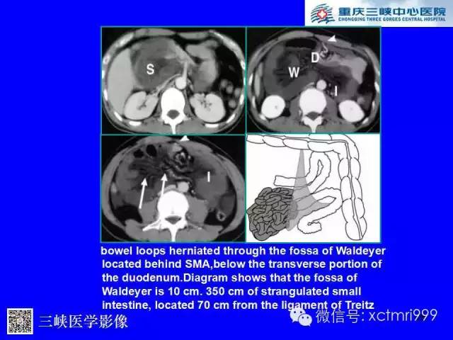 【PPT】腹内疝的影像诊断