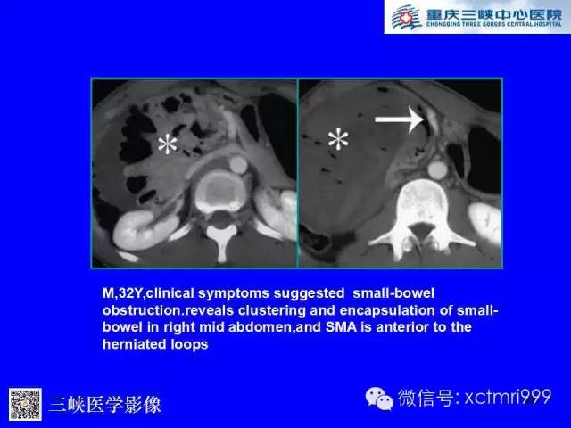 【PPT】腹内疝的影像诊断