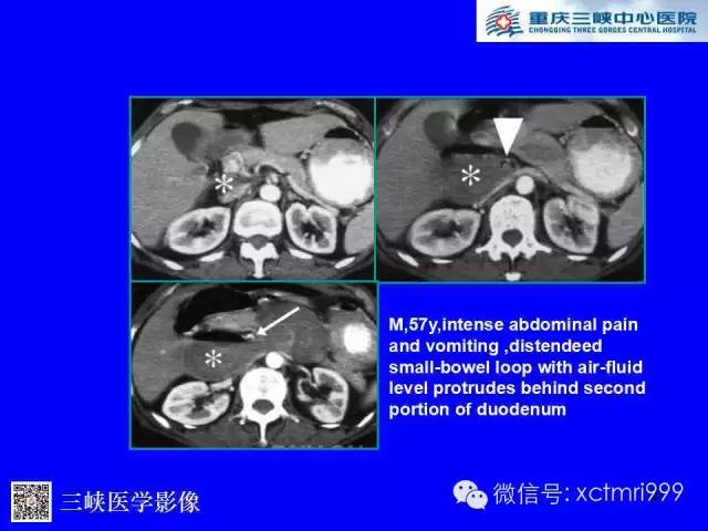 【PPT】腹内疝的影像诊断