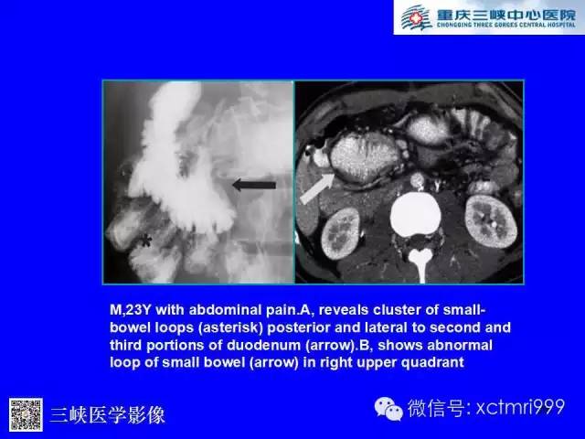 【PPT】腹内疝的影像诊断
