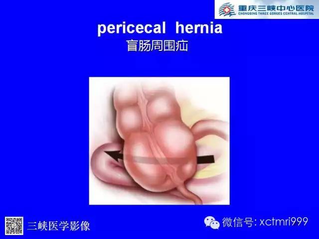 【PPT】腹内疝的影像诊断