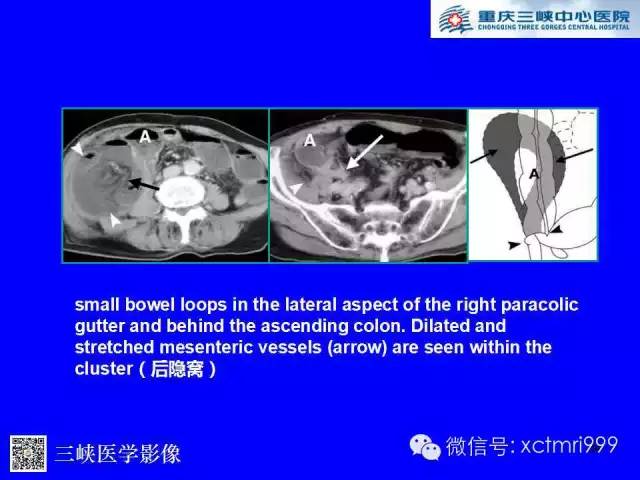 【PPT】腹内疝的影像诊断