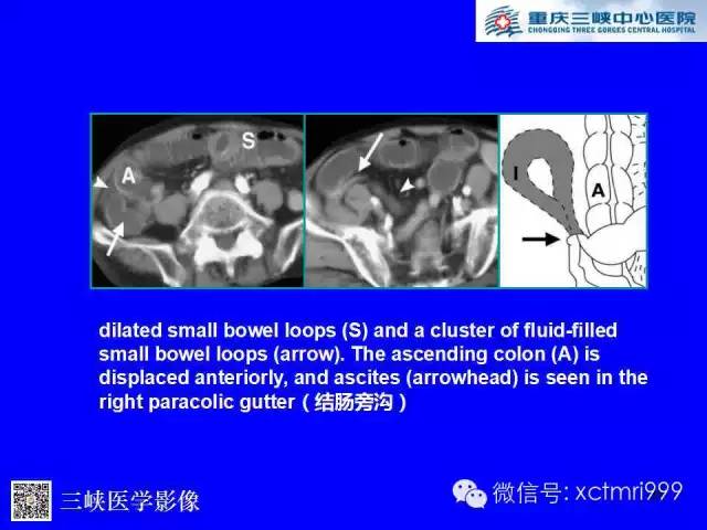 【PPT】腹内疝的影像诊断