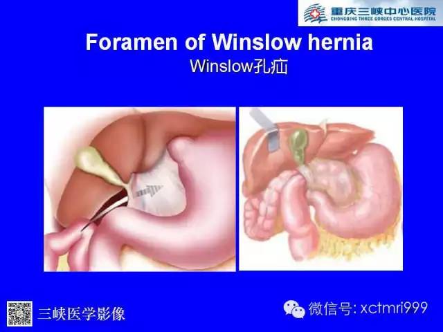 【PPT】腹内疝的影像诊断