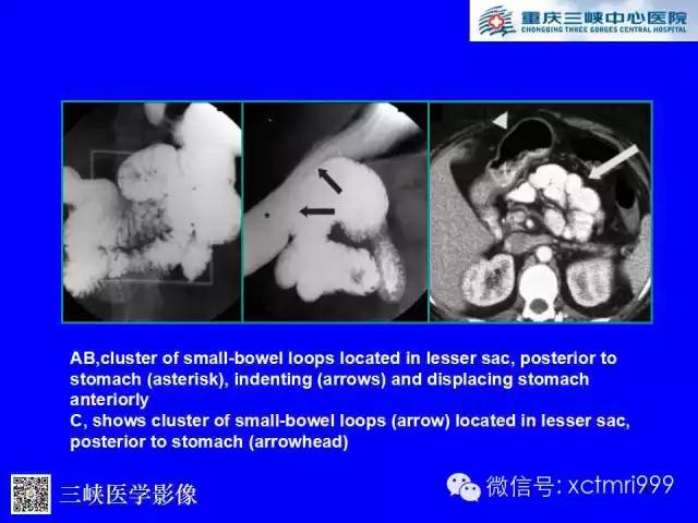 【PPT】腹内疝的影像诊断