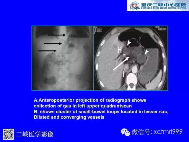 【PPT】腹内疝的影像诊断
