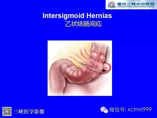 【PPT】腹内疝的影像诊断
