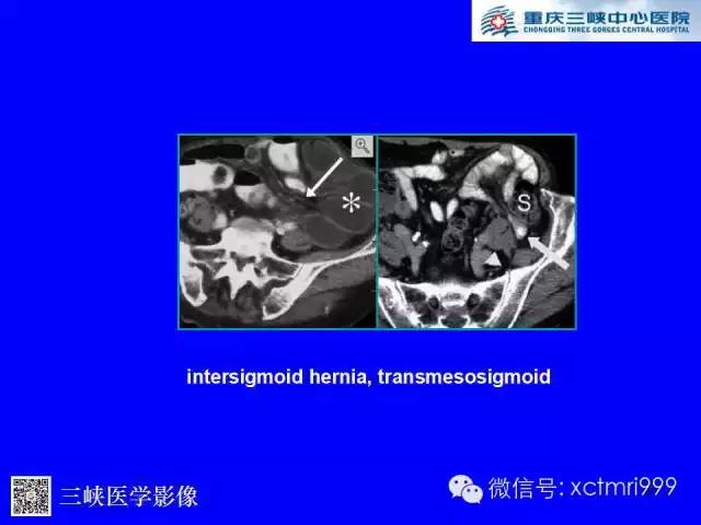 【PPT】腹内疝的影像诊断