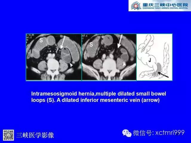 【PPT】腹内疝的影像诊断