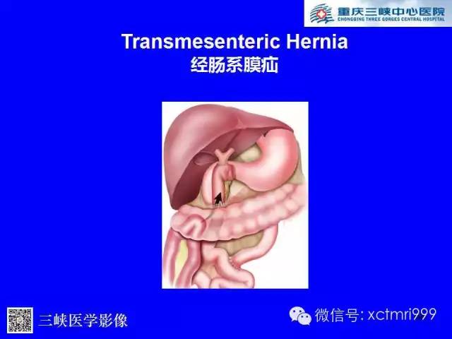 【PPT】腹内疝的影像诊断