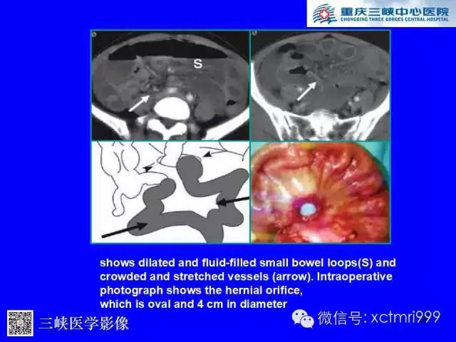 【PPT】腹内疝的影像诊断