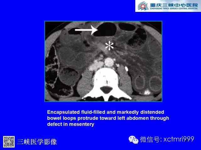 【PPT】腹内疝的影像诊断