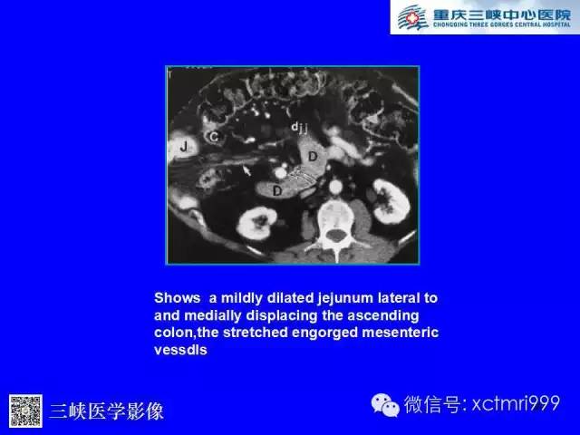 【PPT】腹内疝的影像诊断
