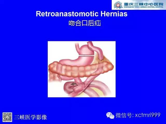 【PPT】腹内疝的影像诊断