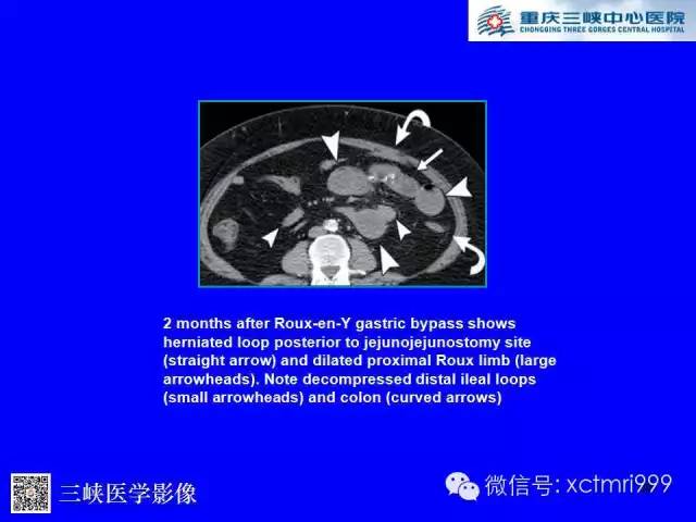 【PPT】腹内疝的影像诊断