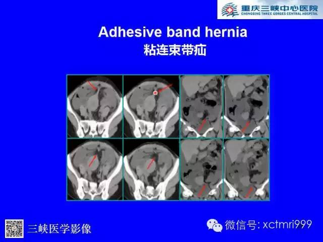 【PPT】腹内疝的影像诊断