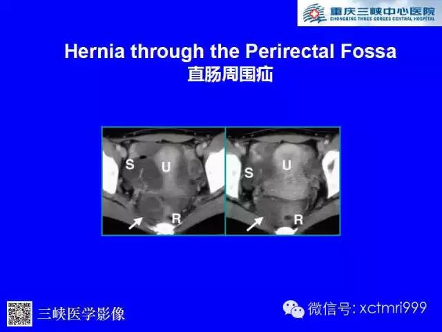 【PPT】腹内疝的影像诊断